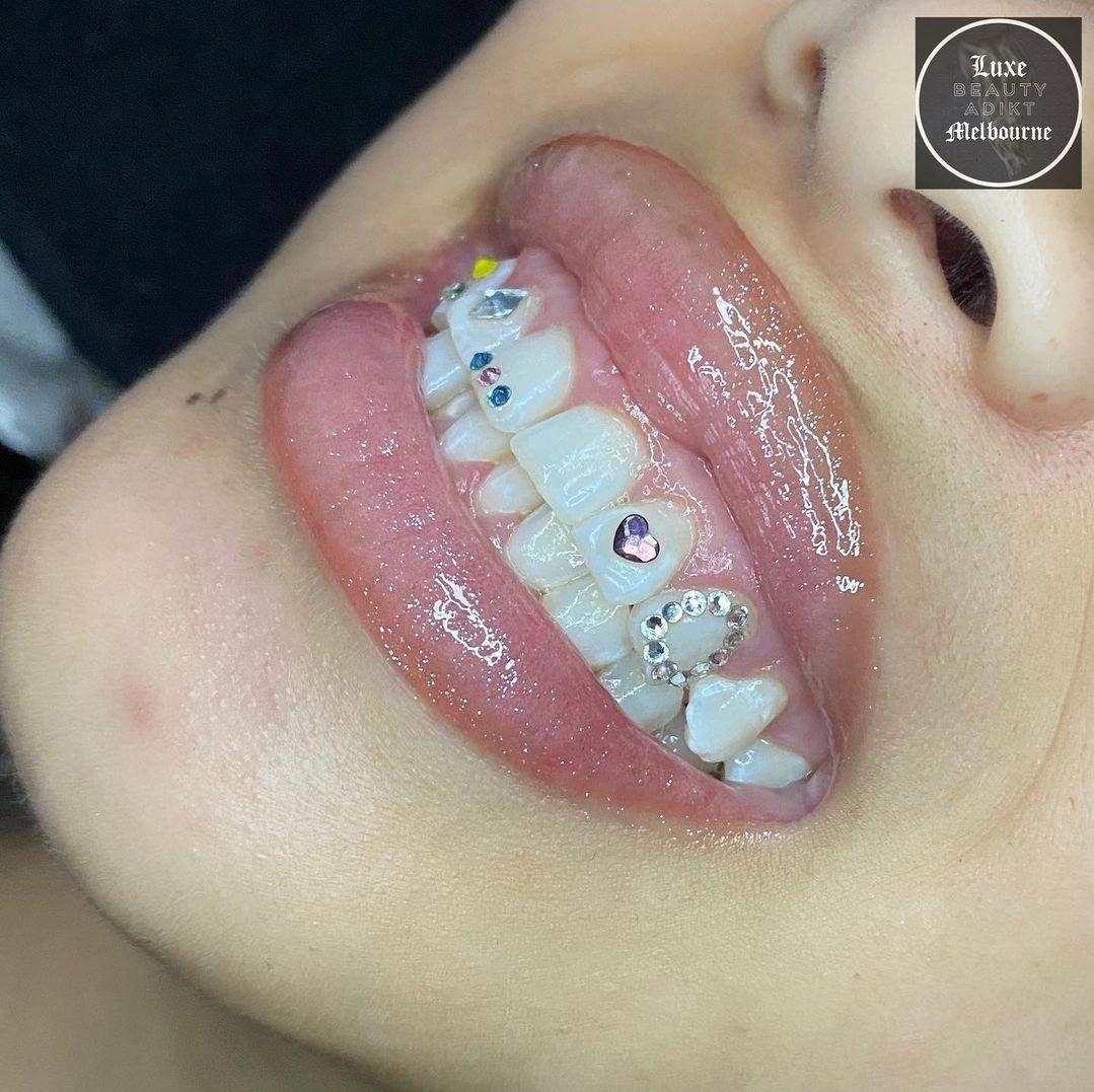 BUTTERFLY Tooth Gem -  Canada  Tooth gem, Teeth jewelry, Diamond teeth